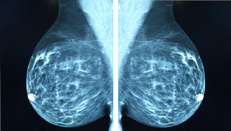 3D Mammogram