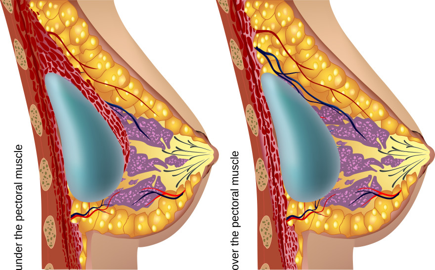 Illustration of under and over muscle breast implants