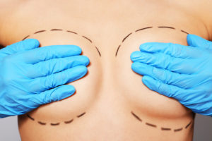 Breast augmentation revision