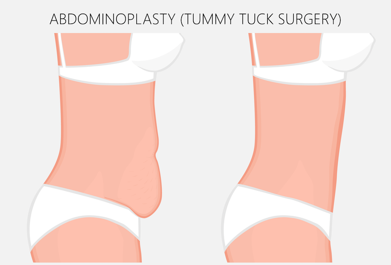 Tummy Tuck