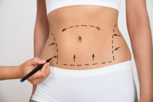 Abdominoplasty Surgery