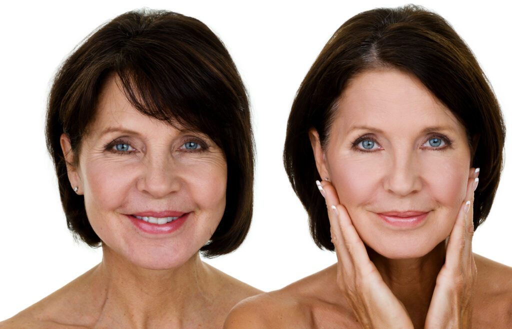 SMILE LINES - Before and After - Dr Tracy Pfeifer