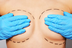 When to Consider Breast Implant Revision or Replacement Surgery - Dr. Tracy Pfeifer