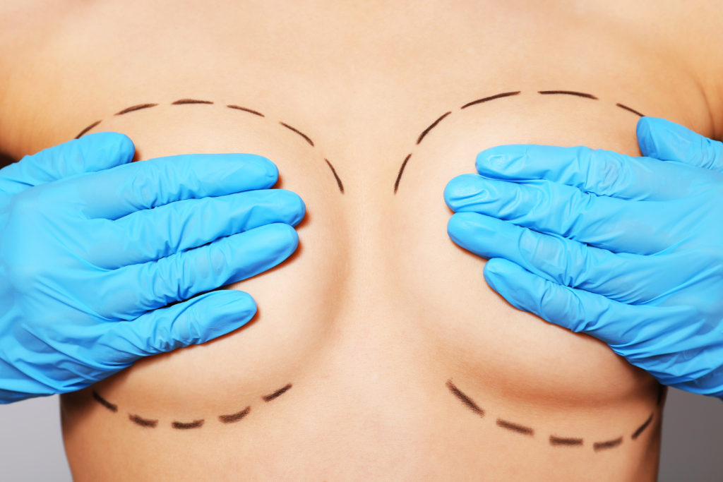 When to Consider Breast Implant Revision or Replacement Surgery - Dr. Tracy Pfeifer